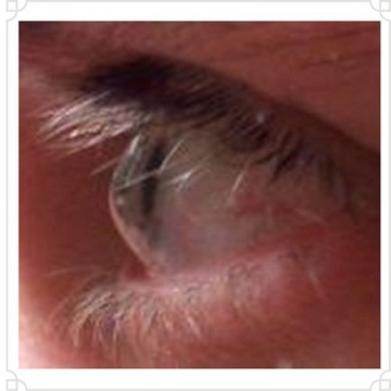 keratoconus 2 jpg