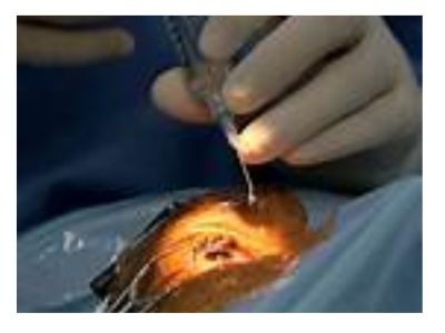 cataract surgery photo